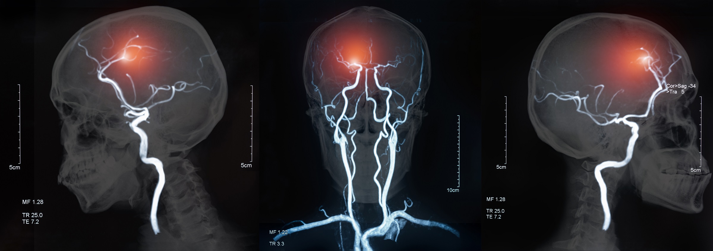 Drei Röntgenaufnahmen eines Gehirns mit einem Schlaganfall